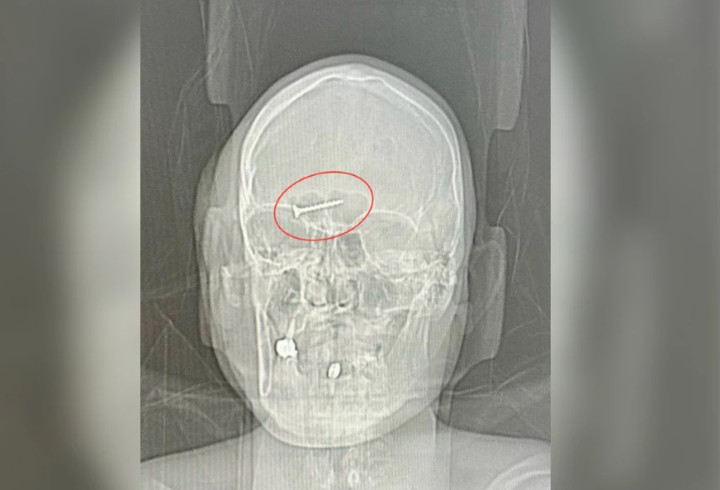 Петербургские хирурги спасли мужчину с шурупом и резиновым шариком в голове